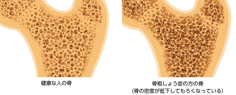 骨粗しょう症とは？についての画像