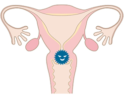 今から始める健康づくり　キラリ☆健康おおたボリューム.50_感染症によるがんのリスクをご存じですか？　子宮頸がんについての画像