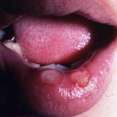 梅毒の症状第1期（口）