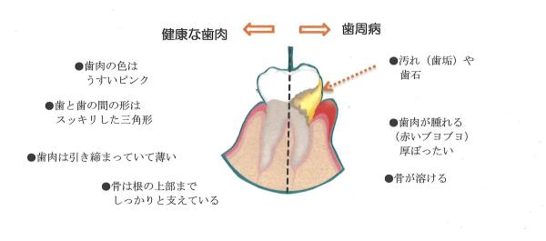 歯周病説明の図